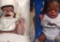 Perjuangan Hidup Bayi Ja'bari, Lahir Tanpa Kulit dengan Berat 1,12 kg hingga Berhasil Tertutup Kulit Sepenuhnya dan Beratnya Jadi 6,7 kg