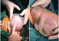 Bayi Laki-laki Ini Dilahirkan dalam Keadaan Masih Terbungkus Kantung Ketuban, Diangkat dengan 'Damai' dari Perut Ibunya