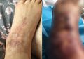 Wanita 41 Tahun Ini Nyaris Kehilangan Kakinya Setelah Alami Infeksi Membusuk Saat Berada di Tepi Kolam Renang Karena Hal Ini