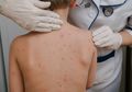 Lupus Bisa Terjadi Pada Anak, Kenali Gejala Awalnya Berikut Ini