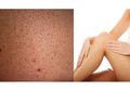 Hilangkan Bintik Merah Usai Cukur Bulu Kaki, #5MenitAja dengan Bahan Alami Ini