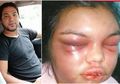 Gila! Pria Ini Tega Pukuli Istrinya Hingga Babak Belur Hanya Karena 'Like' di Facebook