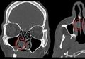 Sering Pusing Mendadak, Dokter Terkejut Ada Ganja Tersangkut di Dalam Hidung Pria Ini Selama 18 Tahun, Kok Bisa?
