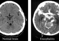 Mengenal Encephalitis, Infeksi Otak yang Jadi Penyebab Alfin Lestaluhu Meninggal Dunia