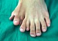 'Mereka Percaya Takhayul,' Ucap Pria yang Hidup dengan 14 Jari Kaki Ini Sehingga Membuatnya Malu Ajak Gadis Berkencan