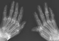 Alami Nyeri Sendi Kronis Selama 40 Tahun, Saat Lakukan X-Ray Ditemukan Serpihan Emas di Dalam Sendi Wanita Ini, Kok Bisa?