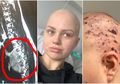 Awalnya Sakit Punggung, Ibu Muda Ini Didiagnosis Kanker Langka yang Biasanya Menyerang Anak-anak Usia di Bawah 5 Tahun