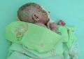 Bayi Ini Tersiksa Karena Kulitnya Keras Seperti Plastik dan Mengelupas hingga Berdarah, Simak Faktor Penyebab Dermatitis Seboroik dan Cara Merawatnya