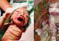 Dulu Didiagnosis Tak Hidup Lama, Bayi Kecil yang Lahir dengan Kondisi Langka Ini Nyatanya Secara Ajaib Bertahan Hidup hingga 6 Tahun Lamanya, Begini Kondisinya Sekarang