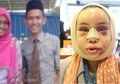 BERITA POPULER: Kisah Pria yang Nikahi Mantan Guru SMA-nya Hingga Wajah Wanita Ini Bengkak 3 Bulan Setelah Jalani Oplas