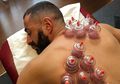 Karim Benzema Pamer Foto Lagi Bekam, Ternyata Ini Lho Manfaatnya Bagi Atlet