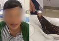 Tiru Adegan di TV, Wanita Ini Lakukan Hal Konyol Sekaligus Sia-sia saat Dirinya Digigit Ular, Ini Cara Benar Menolong Korban Gigitan Ular