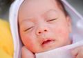 Pipi Bayi Merah Seperti Ini Bisa Jadi Dia Terkana Penyakit Turunan Keluarga, Dermatitis Atopik Tak Bisa Disembuhkan Tapi Dapat Dikendalikan