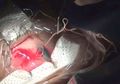 Pria ini Mengeluh Gatal-gatal dan Nyeri Mata, Setelah Diperiksa Dokter Terkejut karena Ada Parasit Sepanjang 7 cm!