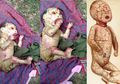 Bukannya Diberi Pertolongan, Bayi Aneh dari India Ini Justru Jadi Bahan Tontonan Warga dan Disebut Makan Usus Ibunya, Beginilah yang Sebenarnya Terjadi pada si Bayi