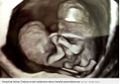 Menolak Saran Aborsi Dokter, Wanita Ini Mantap Lahirkan Bayinya Meski Kondisinya 'Menyedihkan' Tiga Tahun Berlalu Beginilah Kehidupan Anak-anak Malang Ini