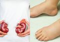Muncul Bengkak Seperti Ini pada Kaki Anda? Waspada, Bisa Jadi Itu Gejala Gagal Ginjal!