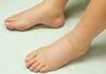 Coba Perhatikan Kaki Anda! Apakah Membengkak? Bisa Jadi Anda Alami Edema, Ini 7 Cara Alami yang Efektif untuk Mengobatinya