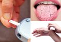 Kulit Gatal dan Mulut Kering, Bisa Jadi Anda Mengidap Diabetes