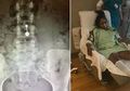 Gunakan KB Spiral, Wanita Ini Mengalami Nasib Mengenaskan, Indung Telurnya yang Menghitam Diangkat Organ Tubuhnya tak Berfungsi hingga Amputasi