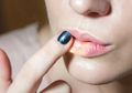 8 Tanda Kesehatan Bisa Dilihat dari Kondisi Bibir, Salah Satunya Bibir Pecah-pecah, Yuk Jangan Dibiarkan Saja!