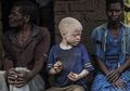 Begilah Nasib Mengerikan yang Dialami Bocah Kulit Putih yang Terlahir dari Orang Tua Kulit Hitam di Afrika, Diangap Keramat Mereka Diperlakukan Begini