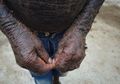 Dijuluki Manusia Ular, Bocah Ini Ganti Kulit Sebulan Sekali dengan Kondisi yang Kering dan Bersisik, Sang Ayah: 'Hati Saya Hancur Setiap Hari Melihatnya'