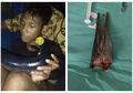 Lagi Asik Mancing, Anak ini Malah Diserang Ikan Hingga Tertusuk di Leher, Begini Kronologinya...