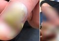 Ngeri! Gara-gara Kebiasaan Gigit Kuku, Jari Cewek Ini Alami Infeksi Parah