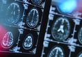 Teknologi AI Buatan IBM Bisa Prediksi Perkembangan Penyakit Huntington