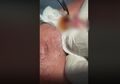 Ngeri, Video Viral Bibir Seorang Pria Keluarkan Larva yang Disebut dari Minuman Kaleng, Ini Penjelasan Ahli