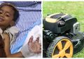 Terputus Gara-gara Mesin Pemotong Rumput, Beruntung Tangan Bocah 4 Tahun Ini Berhasil Disambung Lagi, Begini Cara Dokter Melakukannya
