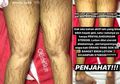 Gegara Salah Pilih Lotion, Kulit Kaki Pasien Dokter ini Mengalami Strech Mark Merah Kehitaman