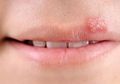 Ini Dia Panduan Singkat Cara Hilangkan Luka Sariawan di Bibir