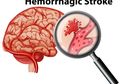 Ini Beberapa Gejala Stroke Hemoragik, Salah Satunya Sakit Kepala Mendadak dan Parah