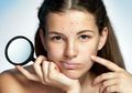 Tidak Perlu Concealer, Ini Cara Mudah Menutupi Bekas Jerawat Membandel