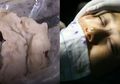 Usai Jalani Operasi Plastik, Bukan Berubah Cantik, Luka Bedah Perempuan Ini Justru Keluarkan Kapas Penuh Lendir dan Darah