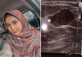 Dikira Hamil di Luar Nikah Usai Unggah Hasil USG, Kesha Ratuliu Angkat Bicara: Itu Adalah Tumor Payudara