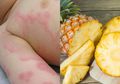 Ini 5 Obat Biduran Alami, Salah Satunya Senyawa yang Terdapat dalam Buah Berwarna Kuning dan Manis Ini