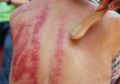 Bisa dengan Tanduk Kerbau atau Sendok Sup, Ternyata China Juga Punya Kebiasaan 'Kerokan' Sendiri, Berikut Manfaat Gua Sha yang Mampu Mengatasi berbagai Penyakit