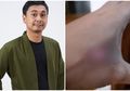 Lama Tak Muncul, Raditya Dika Beri Kabar Soal Tangannya yang Disebutnya Menghitam hingga Dilarikan ke Dokter, Ada Apa?