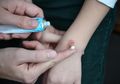 Jangan Keliru, 4 Bahan Ini Sebenarnya Tak Boleh Digunakan untuk Atasi Luka Bakar, Selain Pasta Gigi Apa Lagi Ya?