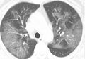 Paru-paru Rusak Disertai dengan Tanda Ini, Beginilah Penampakan Organ Dalam Pasien Penderita Virus Corona Kronis yang Dirilis Oleh Ilmuwan