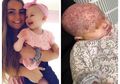 Gara-gara Sering Diciumi, Bayi 6 Bulan ini Terinfeksi Herpes dan Hampir Kehilangan 1 Matanya, Lihat Kondisinya yang Bikin Kasihan