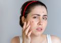 Bukan Ditutupi Makeup, Simak Cara Tepat Atasi Jerawat Agar Wajah Kembali Mulus #SemuaBisaCantik