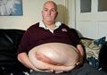 Dean Carron, Seorang Mantan Bodyguard Selebritas yang Hidup dengan ‘Hernia Terbesar di Dunia’, Dokter pun Takut Mengoperasinya