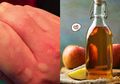 Obat Biduran pada Anak Alami yang Perlu Anda Ketahui, Salah Satunya dengan Cuka Sari Apel, Yuk Simak!