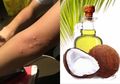 Bila Dirasa Biduran Tak Kunjung Sembuh, Ini Obat Biduran Herbal yang Bisa Dicoba di Rumah, Salah Satunya Minyak Kelapa