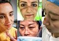 Bukti Pengorbanan Diri Demi Melayani Pasien Covid-19, Ini Deretan Foto Para Petugas Medis dengan Wajah Lebam Merah Nyaris Berdarah