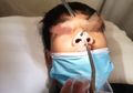 Sering Terasa Gatal, Dokter Temukan Makhluk Penghisap Darah di Hidung Bocah Ini